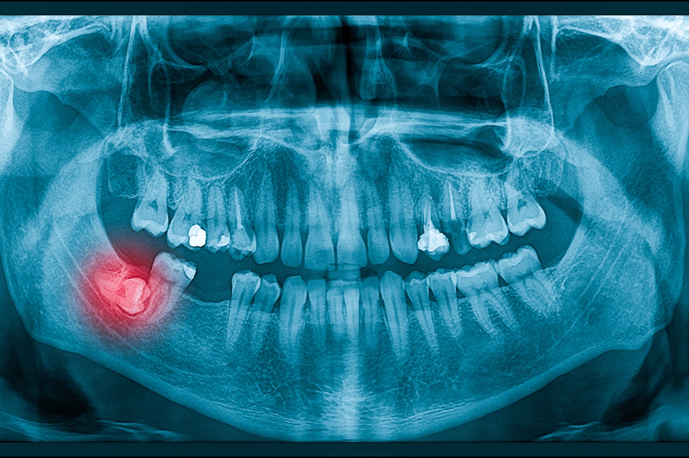 Wisdom teeth removal